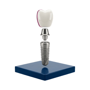 3D-Darstellung eines Zahn-Implantats aus Schraube, Verbinder und Krone